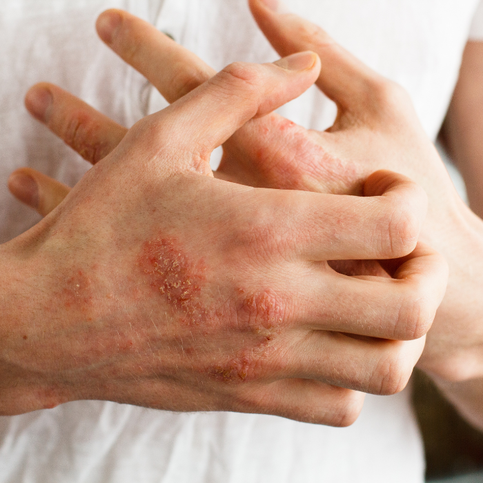 ATOPISCHE-DERMATITIS-KORSTJES-OP-DE-HAND
