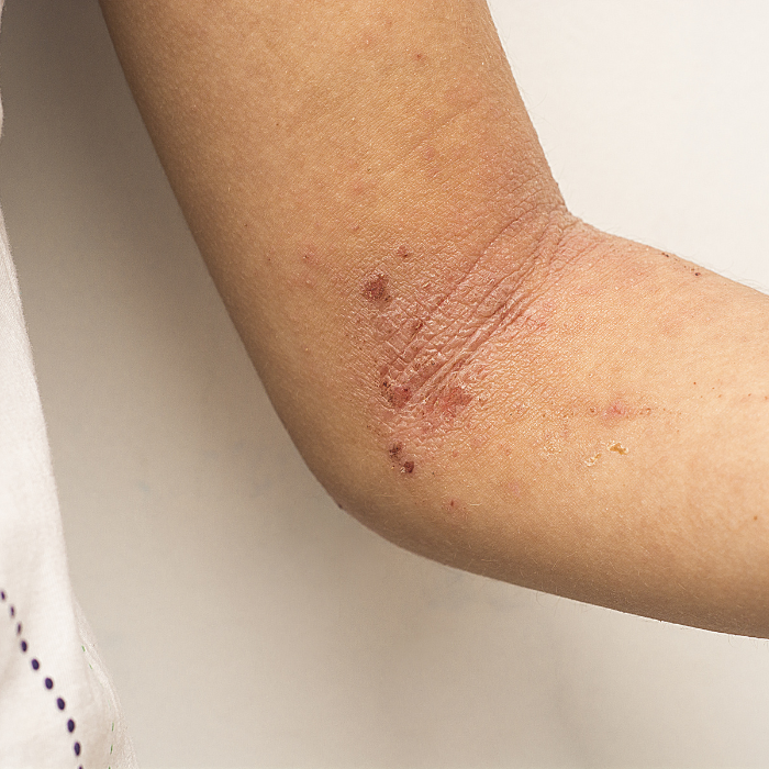 PSORIASIS-OP-EEN-ONDERARM