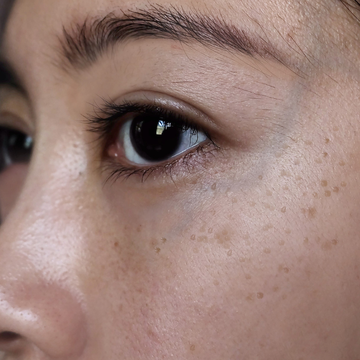 HUID-MET-PIGMENTVLAKKEN-GEZICHT-VROUW