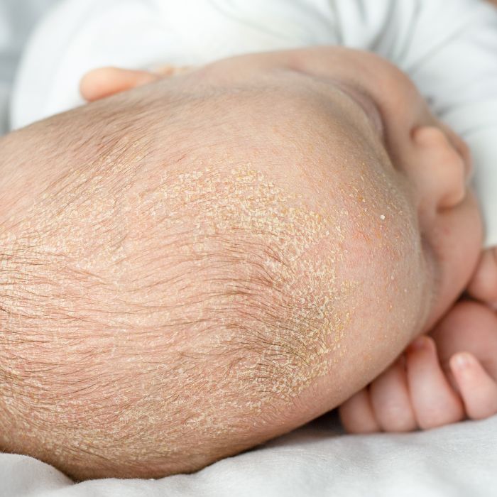 BERG-OP-DE-BOVENKANT-VAN-EEN-BABYSCHEDEL
