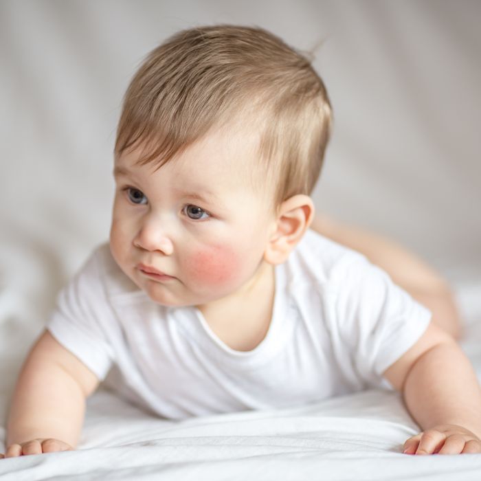 BABY-MET-RODE-EN-GEÏRRITEERDE-WANGEN