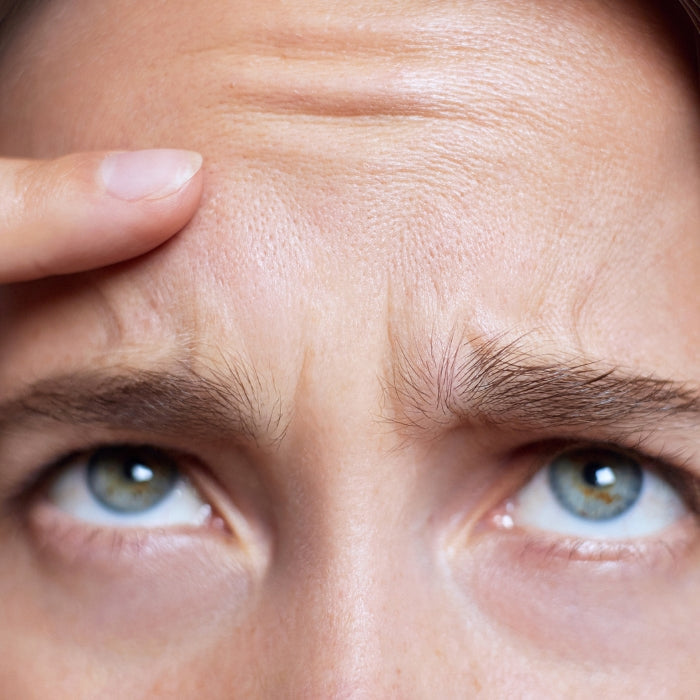 VROUW-MET-RIMPELVORMING-OP-HAAR-VOORHOOFD