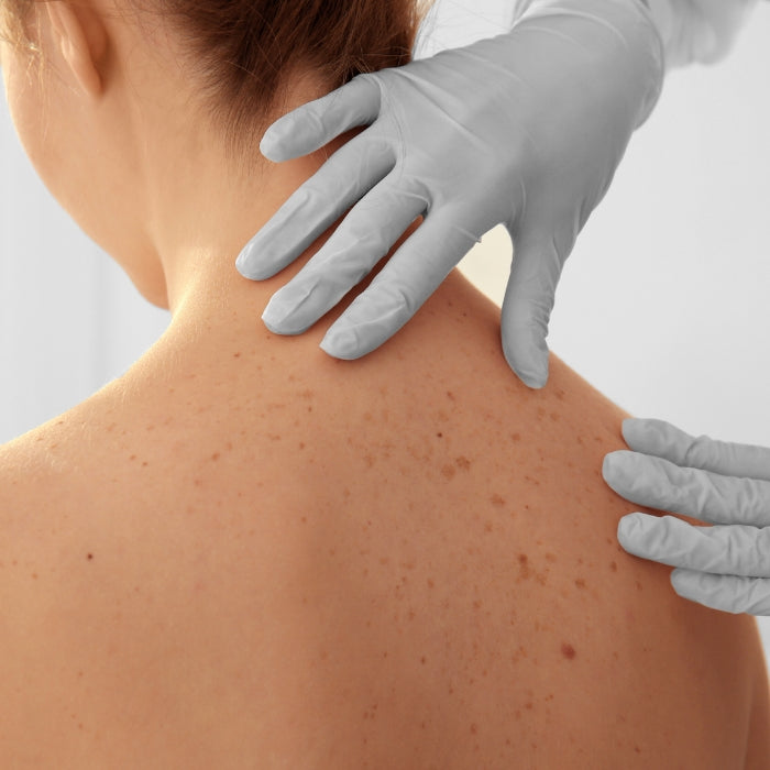 EEN-DERMATOLOOG-ANALYSEERT-DE-RUG-VAN-EEN-PATIËNT-MET-SCHOONHEIDSvlekken