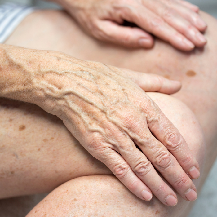 BEEN-EN-HAND-OUDERE-PERSOON-MET-PIGMENTVLEKKEN