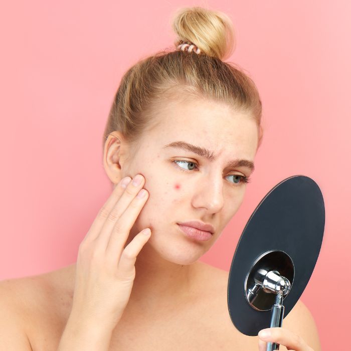 VROUW-MET-ACNE-KIJKT-IN-DE-SPIEGEL