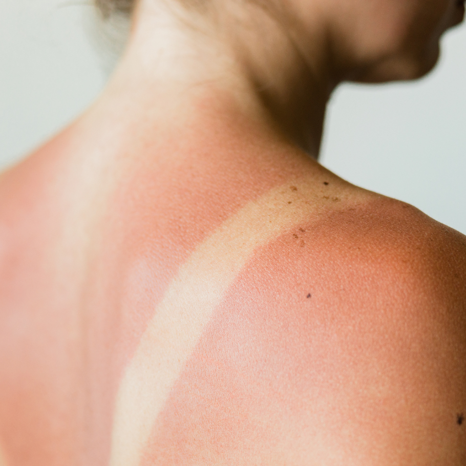 COUP-DE-SOLEIL-SUR_EPAULE