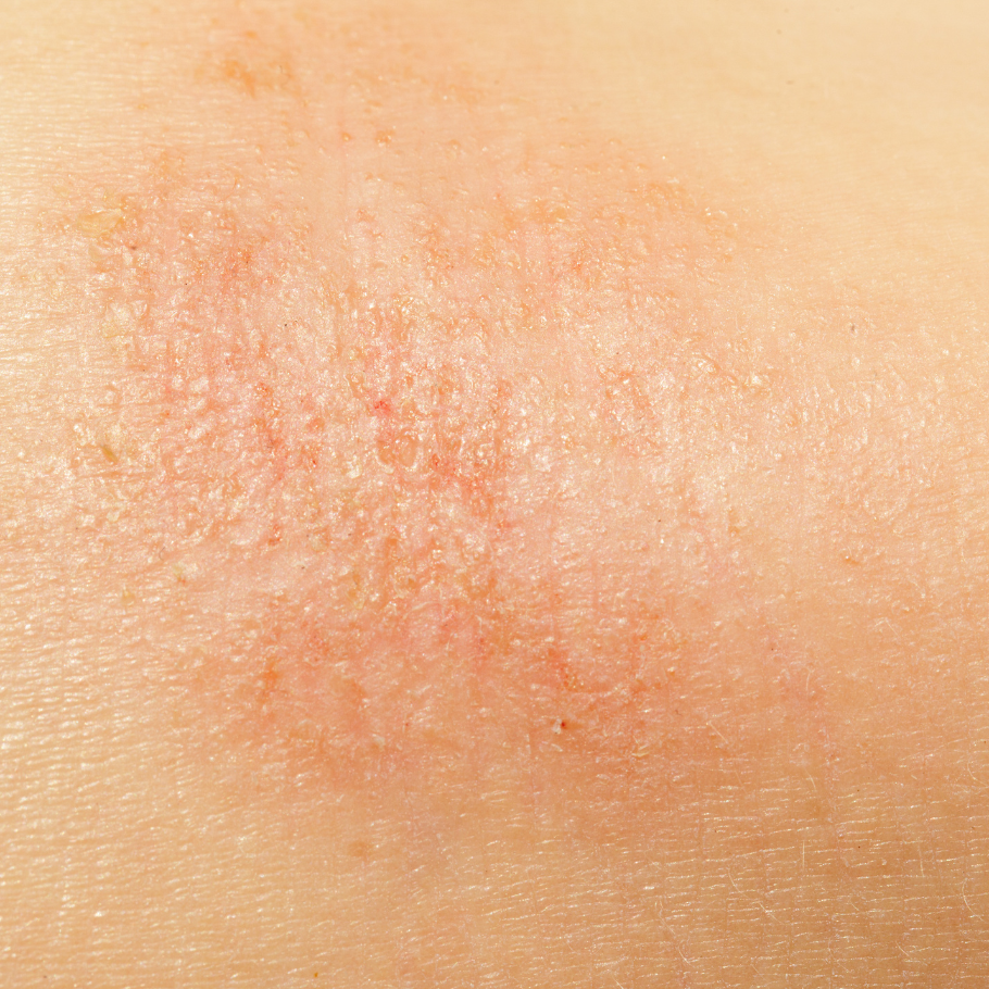 PEAU-IRRITEE-TRES-SECHES