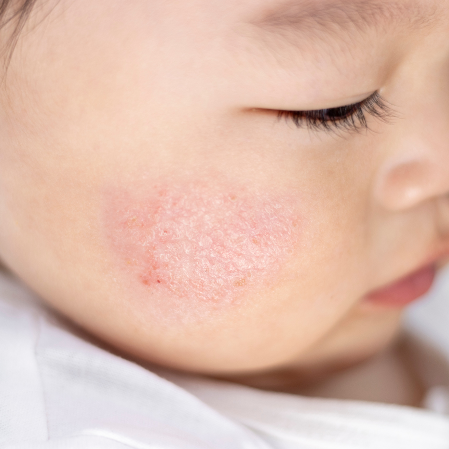 BEBE-VISAGE-IRRITE